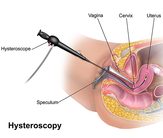 Hysteroscopy for uterine polyps, fibroid removal, and infertility evaluation at Krishvi IVF Centre in Bopal, Ahmedabad — painless, scar-free gynecological procedures trusted by women across Shilaj, South Bopal, and Shela.