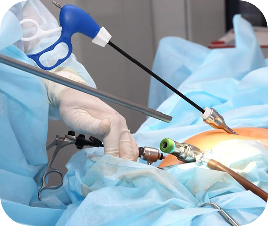 Advanced laparoscopic surgery for fibroids, endometriosis, and ovarian cysts at Krishvi IVF & Women’s Hospital in South Bopal, Ahmedabad — expert gynecology care with minimal cuts and faster recovery for patients from Shela, Ghuma, and Thaltej.