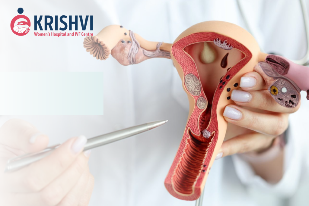 Comprehensive guide on endometriosis showing symptoms, grades, chocolate cysts, fertility impact, and IVF success in advanced endometriosis at Krishvi IVF Ahmedabad.
